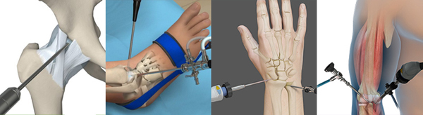 Elbow, Wrist, Hip and Ankle Arthroscopy