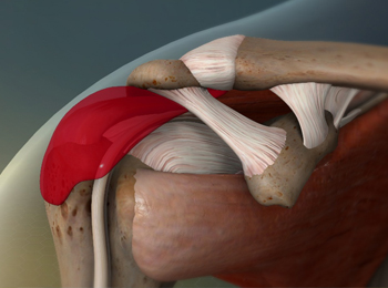 Bursitis