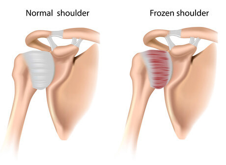 Frozen Shoulder