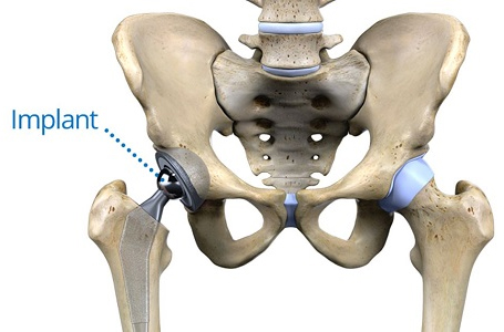 Joint Replacement