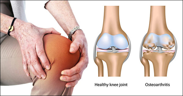 Osteoarthritis