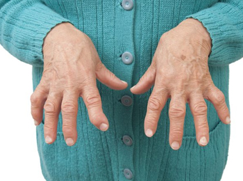 Rheumatoid Arthritis