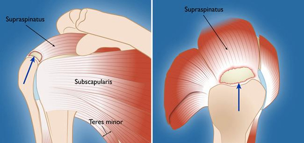 Rotator Cuff Tear Treatment Bangalore,India